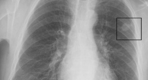 La tasa de supervivencia del cáncer de pulmón aumenta
