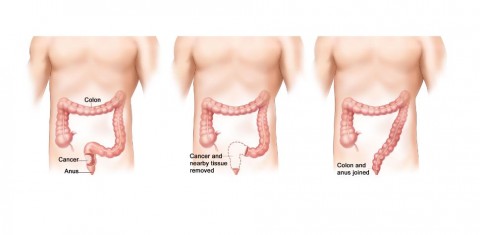 Descubierta una nueva causa de resistencia a quimioterapia en cáncer de colon