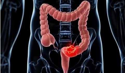 ¿Qué saben los españoles sobre el cáncer de colon?
