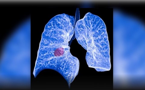 Nueva terapia dirigida reduce a la mitad el riesgo de progresión en cáncer de pulmón