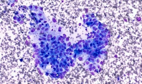 Un análisis en biopsia líquida para detectar el cáncer de páncreas en sus primeras fases