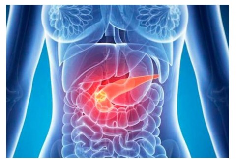 Nueva diana terapéutica que podría ser clave en cáncer de páncreas