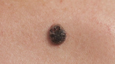 La mortalidad en melanoma se reduce a la mitad con un diagnóstico precoz