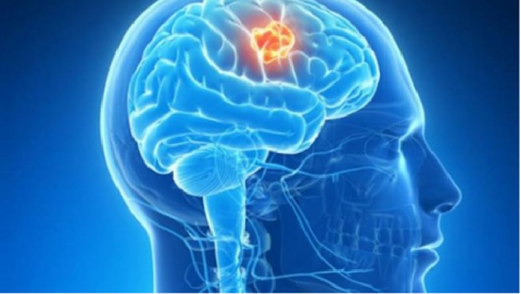 La clasificación molecular de los tumores cerebrales permitirá mejores tratamientos