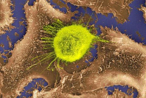 El ADN determina el éxito del tratamiento con inmunoterapia