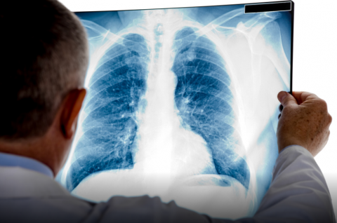 Un fármaco dirigido muestra en pacientes de cáncer de pulmón una respuesta de más de dos años