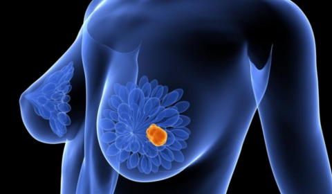 Ya en ensayos un nuevo tratamiento prometedor para cáncer de mama triple negativo