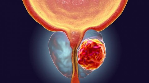 Sintomatología, Causas y tratamiento para el Cáncer de próstata