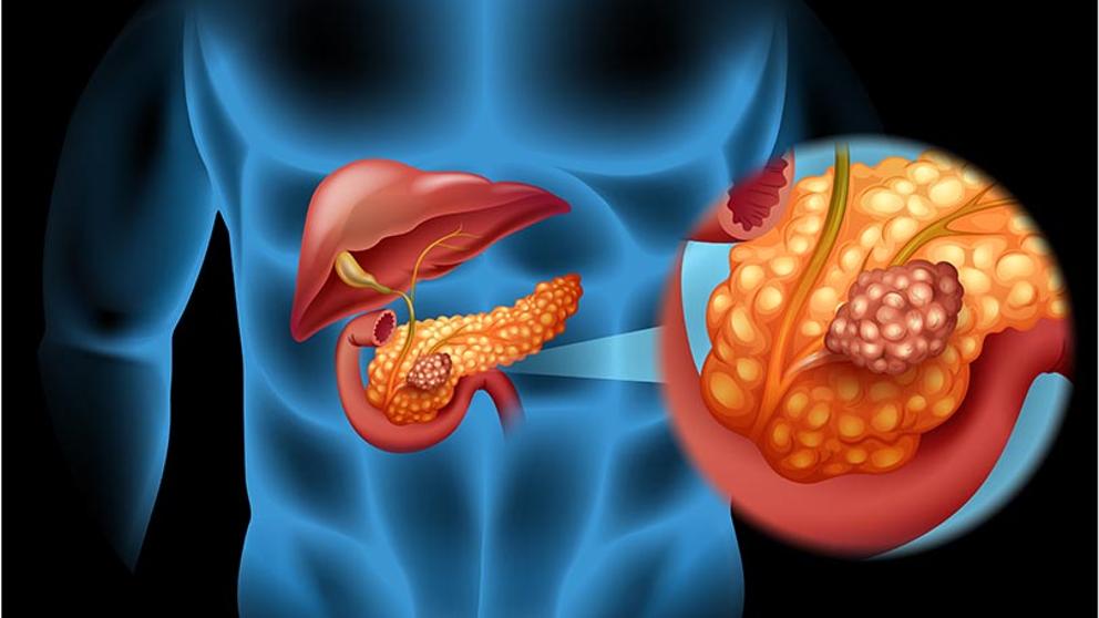 El proceso metastásico en el cáncer de páncreas.