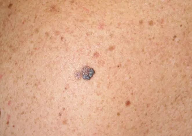 El papel de la inmunoterapia en el melanoma.