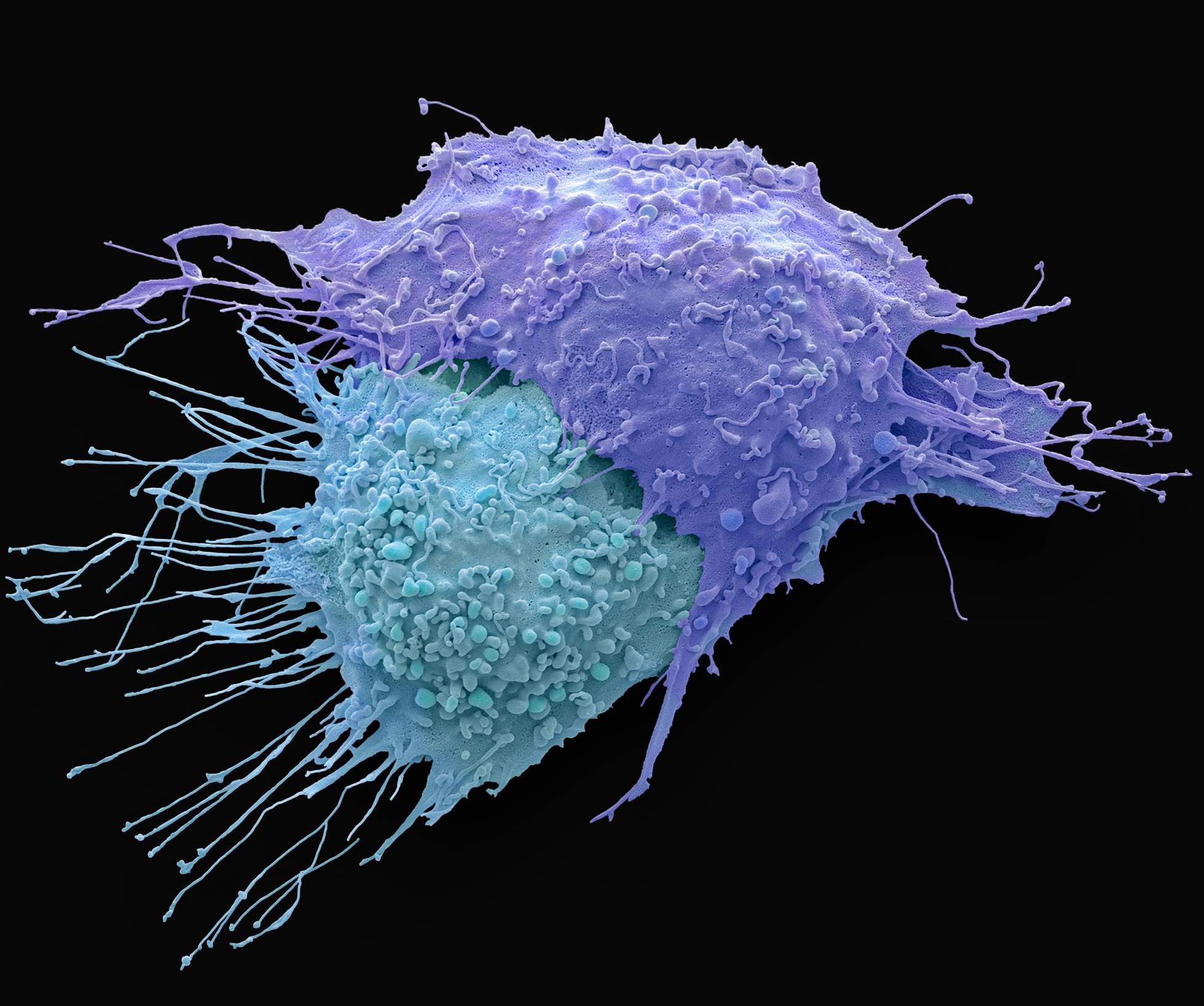 Un estudio genómico abre la posibilidad de detectar el cáncer antes de que aparezca.
