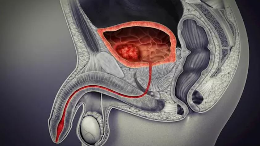 Nuevas opciones terapeúticas para el cáncer de vejiga metastásico.