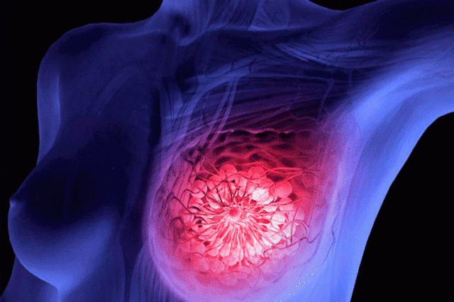 cancer-de-mama-metastasico-640x427