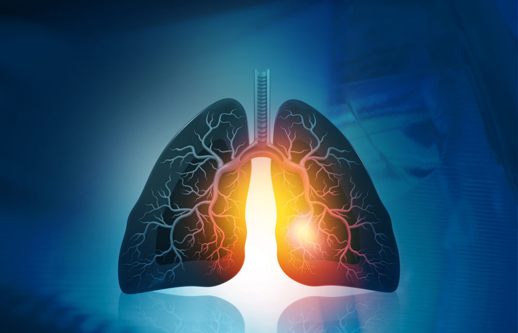 Los inhibidores de ALK, una revolución en cáncer de pulmón con mayor supervivencia y calidad de vida.